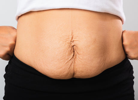 Close up of a woman showing loose lower abdomen skin to help illustrate How Do You Remove Loose Skin After Weight Loss